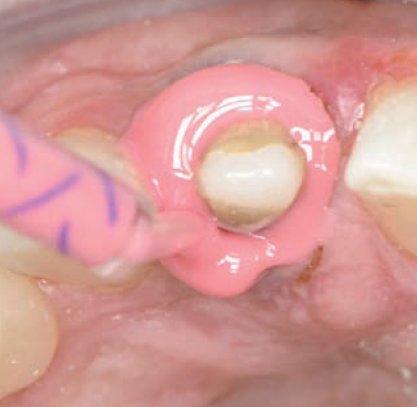 3M™ Impregum™ Intra-oral Syringe Einwegspritze Anwendung