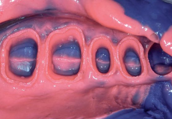 3M Impregum Abformung