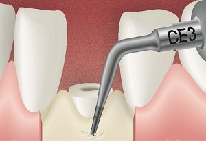 Arbeit Crown Extension