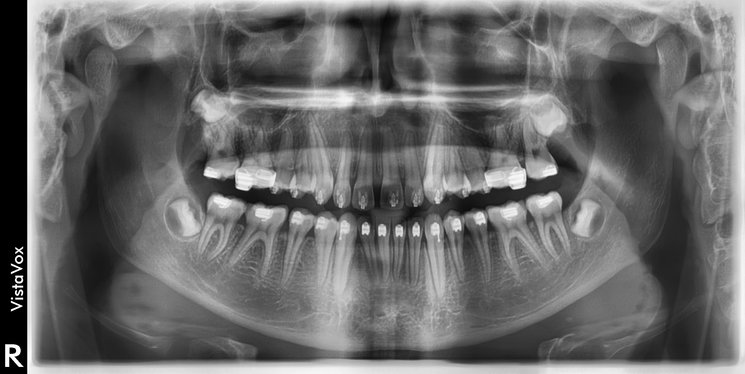 Dürr VistaVox S OPG Aufnahme