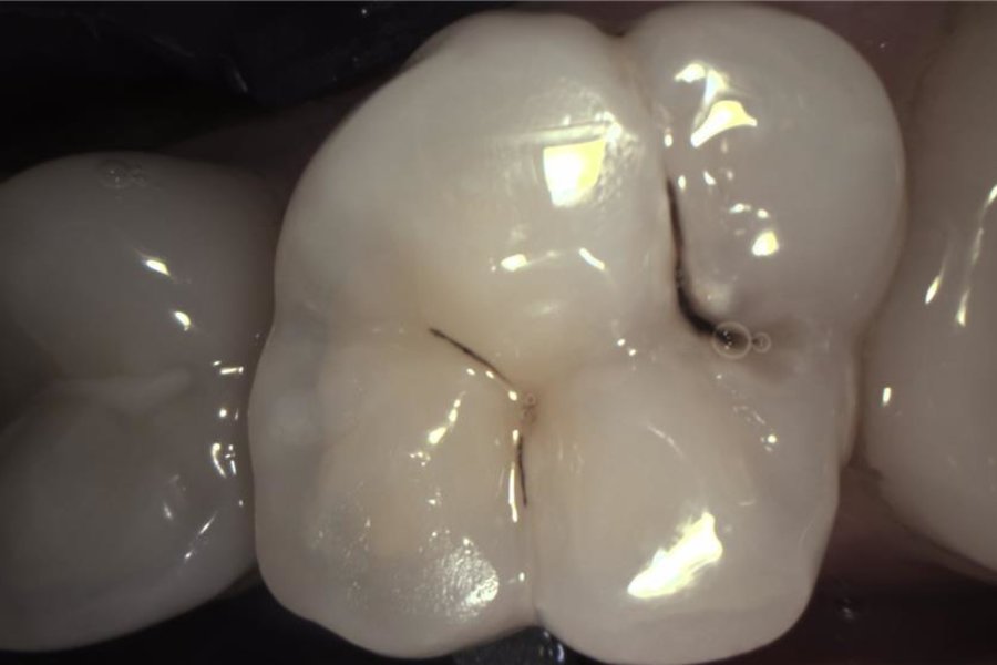 KaVo DIAGNOcam Vision Full HD Intraoral